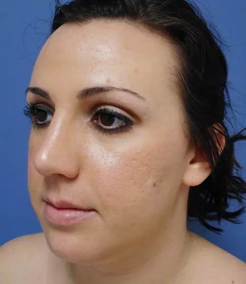 Rhinoplasty Before & After Pictures in Nashville, TN
