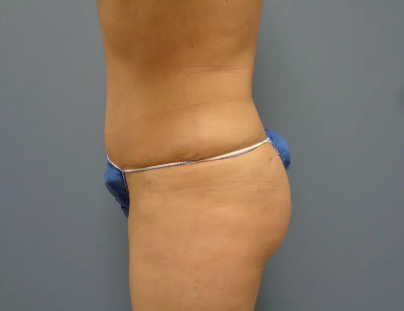 Butt Augmentation Before and After Pictures Nashville, TN