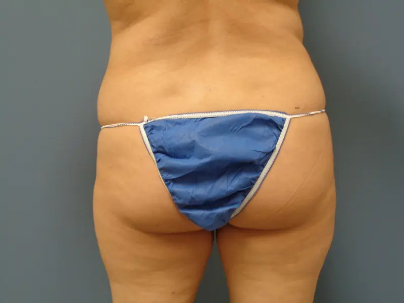 Butt Augmentation Before and After Pictures Nashville, TN