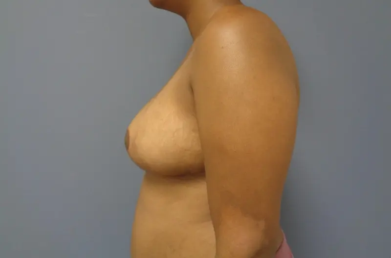 Breast Reduction Before and After Pictures Nashville, TN