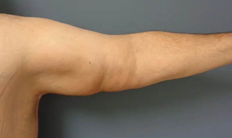 Arm Lift Before and After Pictures Nashville, TN