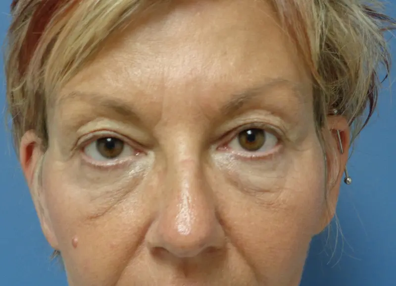Blepharoplasty Before and After Pictures Nashville, TN