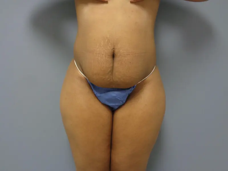 Mommy Makeover Before and After Pictures Nashville, TN