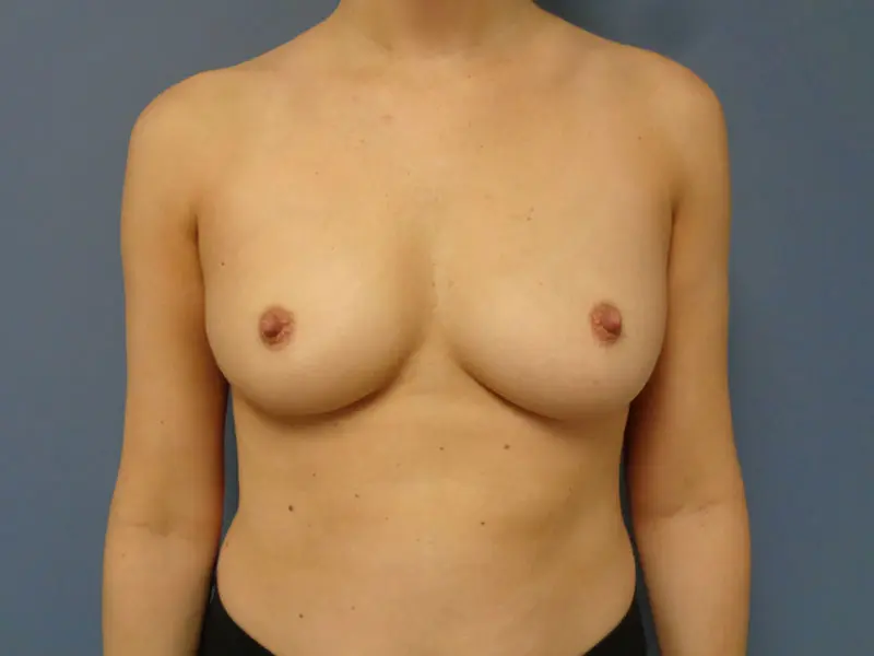 Breast Augmentation Before and After Pictures Nashville, TN