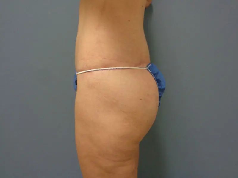 Butt Augmentation Before and After Pictures Nashville, TN