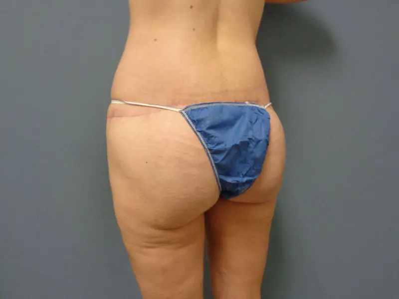 Butt Augmentation Before and After Pictures Nashville, TN