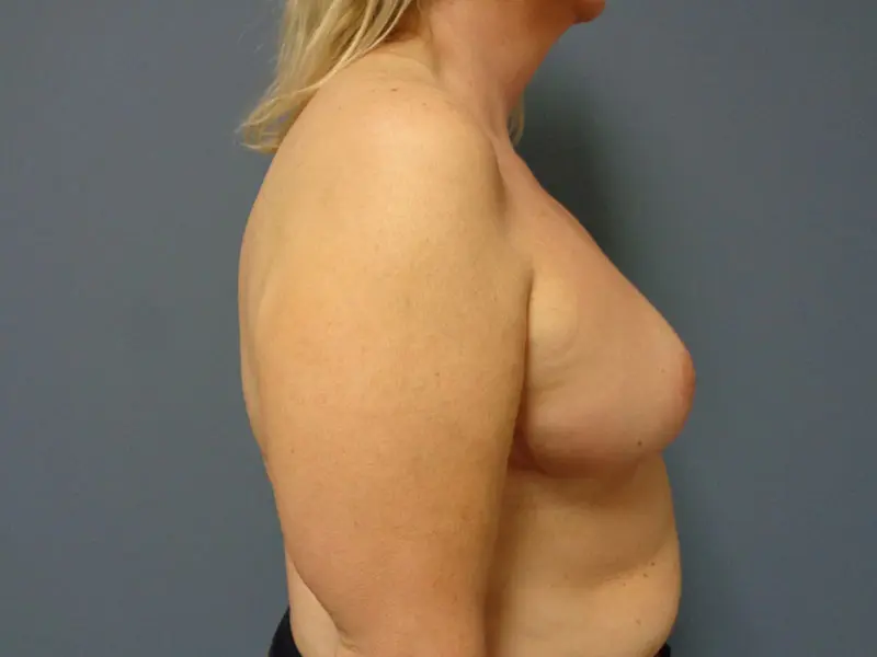 Based Reduction Before and After Pictures Nashville, TN
