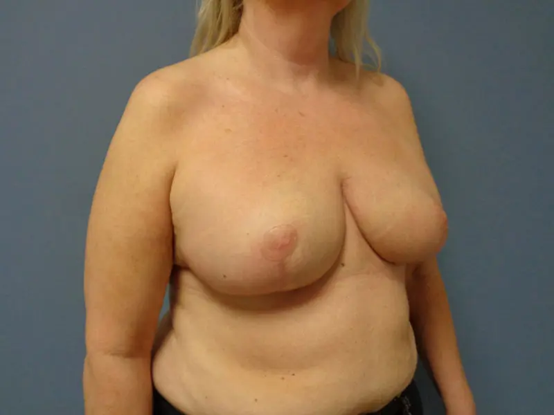 Based Reduction Before and After Pictures Nashville, TN