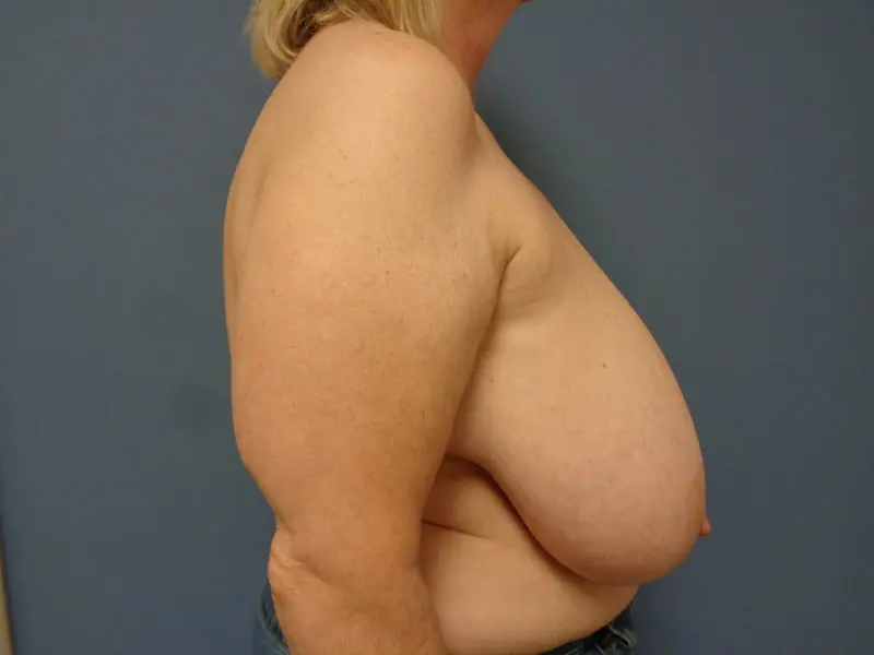 Based Reduction Before and After Pictures Nashville, TN