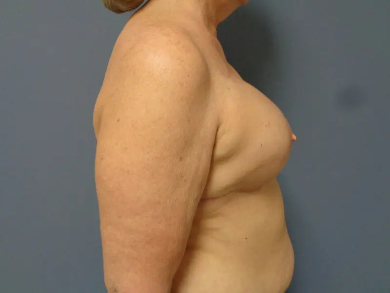 Implant Based Reconstruction Before and After Pictures Nashville, TN