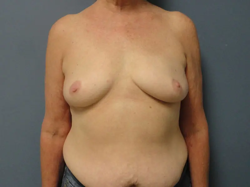 Implant Based Reconstruction Before and After Pictures Nashville, TN