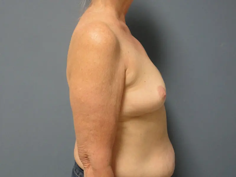 Implant Based Reconstruction Before and After Pictures Nashville, TN