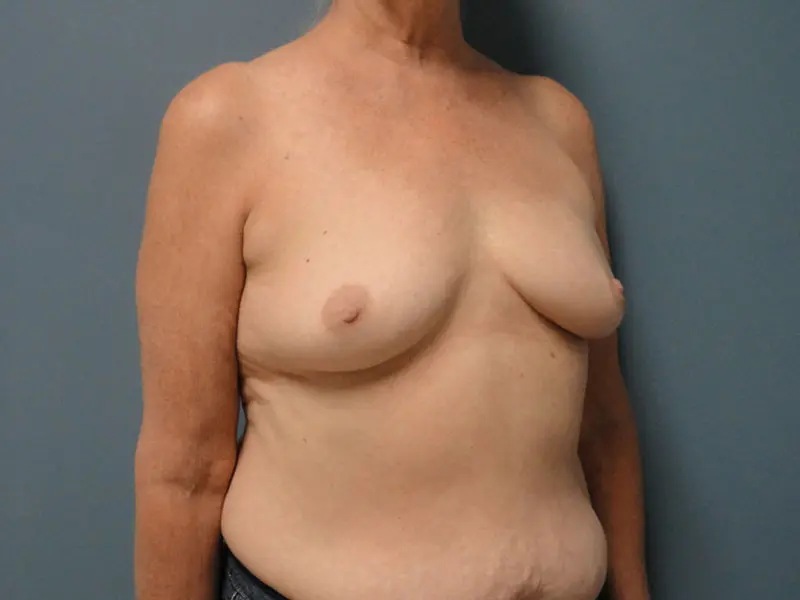 Implant Based Reconstruction Before and After Pictures Nashville, TN