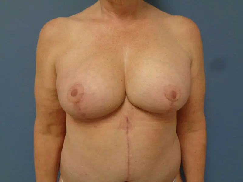 Mommy Makeover Before and After Pictures Nashville, TN
