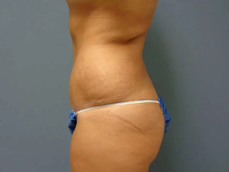 Tummy Tuck Before and After Pictures Nashville, TN