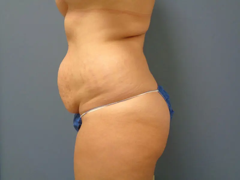Tummy Tuck Before and After Pictures Nashville, TN
