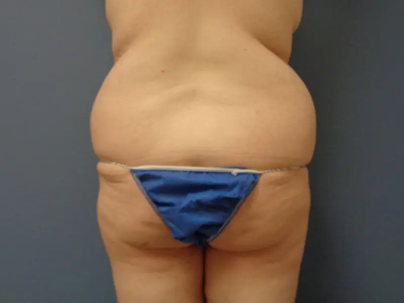 Butt Augmentation Before and After Pictures Nashville, TN