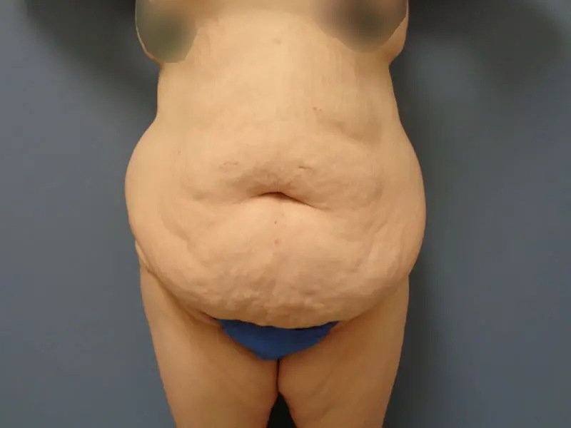 Body Lift Before & After Pictures in Nashville, TN