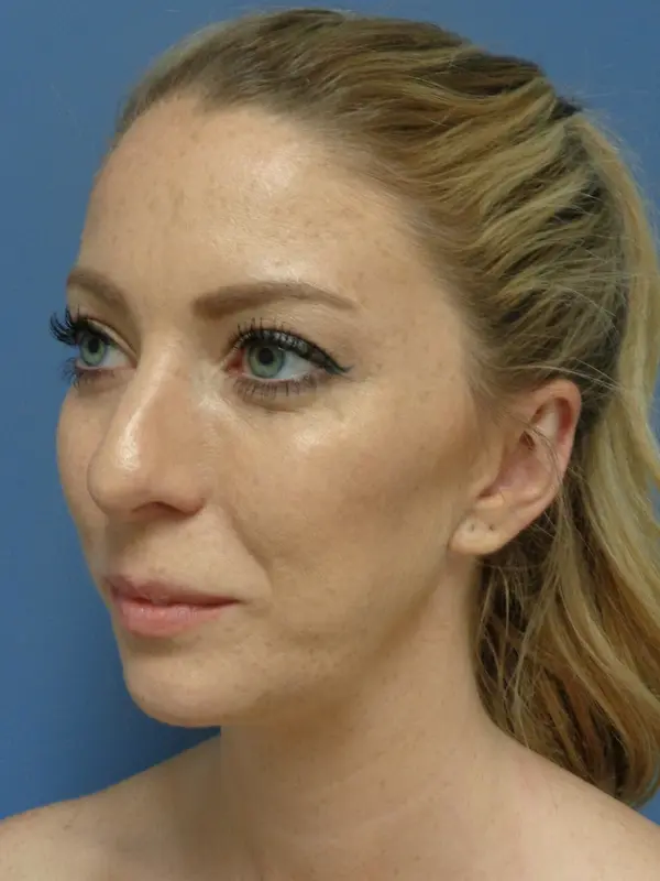 Otoplasty Before and After Pictures Nashville, TN