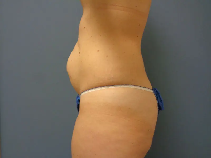 Tummy Tuck Before and After Pictures Nashville, TN