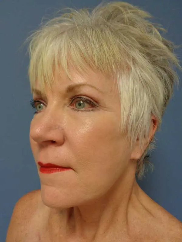 Facelift Before and After Pictures Nashville, TN