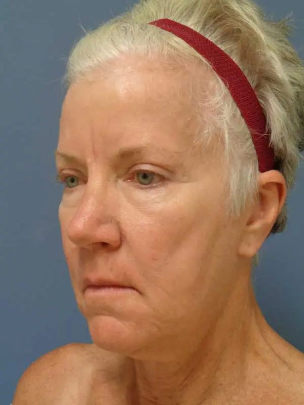 Facelift Before and After Pictures Nashville, TN