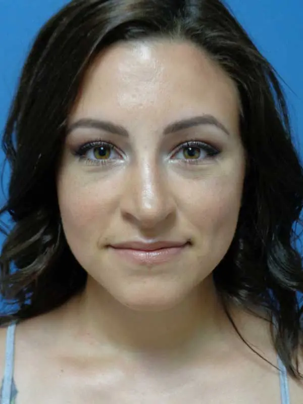 Rhinoplasty Before and After Pictures Nashville, TN
