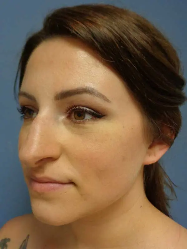 Rhinoplasty Before and After Pictures Nashville, TN