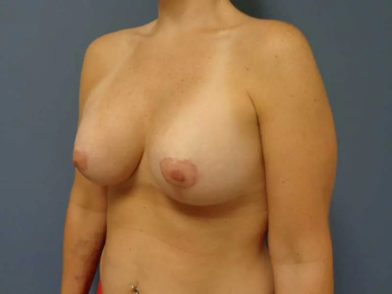 Breast Augmentation with Lift Before and After Pictures Nashville, TN