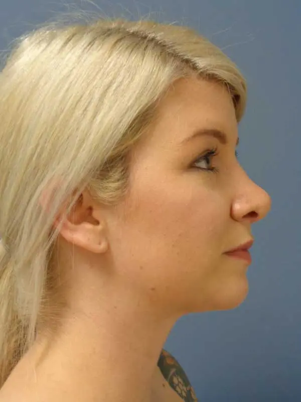 Rhinoplasty Before and After Pictures Nashville, TN