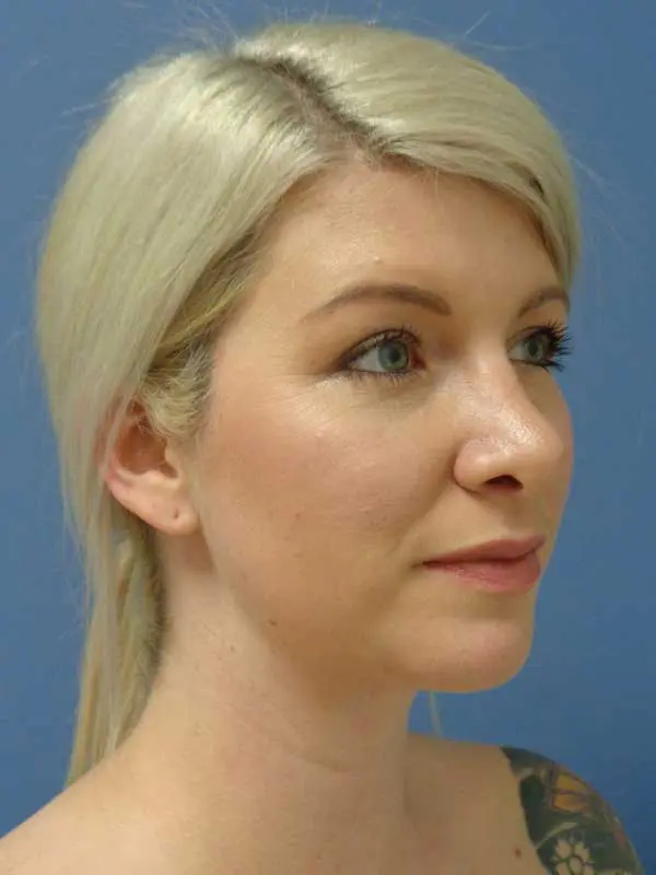 Rhinoplasty Before and After Pictures Nashville, TN