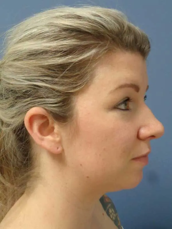 Rhinoplasty Before and After Pictures Nashville, TN