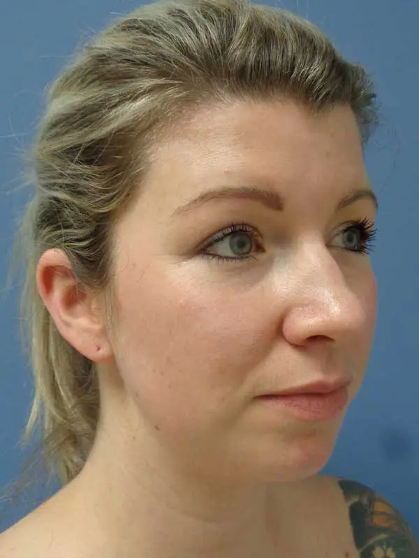 Rhinoplasty Before and After Pictures Nashville, TN