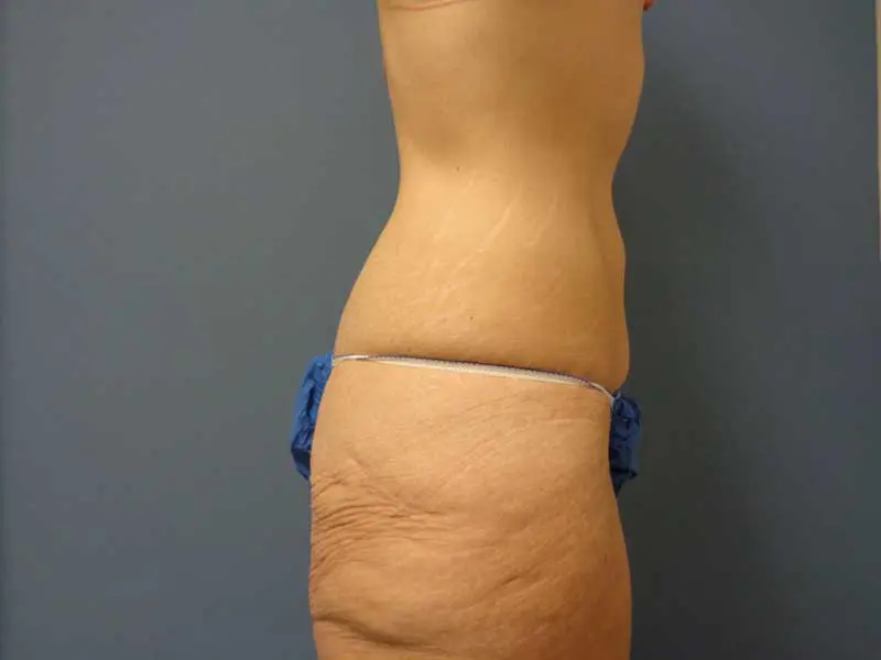 Tummy Tuck Before and After Pictures Nashville, TN