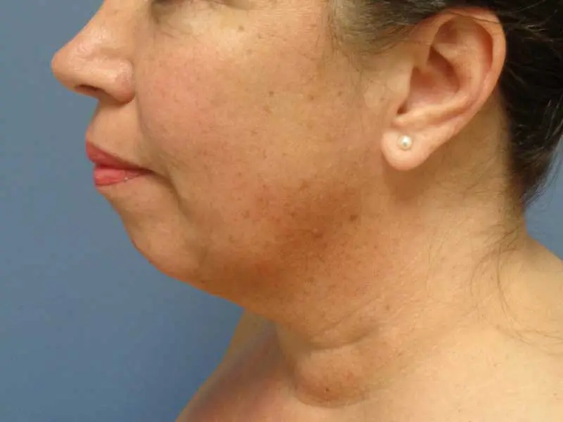 Chin Augmentation Before and After Pictures Nashville, TN