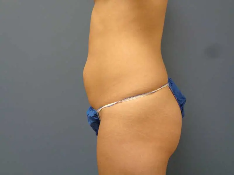 Mommy Makeover Before and After Pictures Nashville, TN
