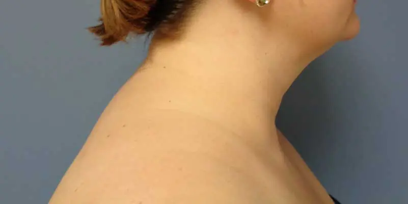 Liposuction Before & After Pictures in Nashville, TN