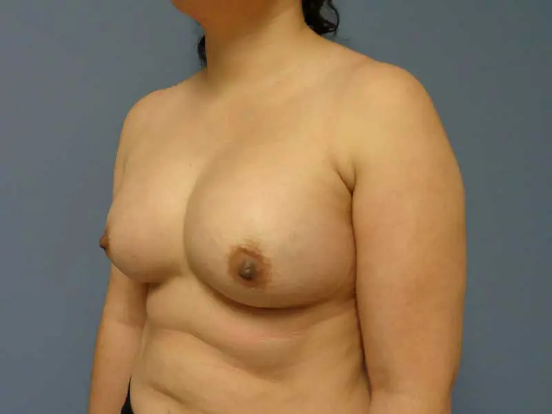 Breast Augmentation Before & After Pictures in Nashville, TN