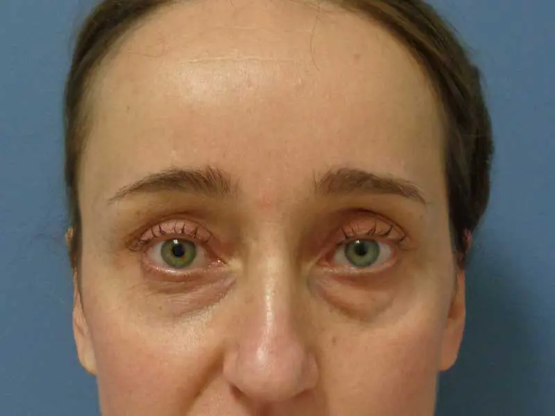 Blepharoplasty Before & After Pictures in Nashville, TN