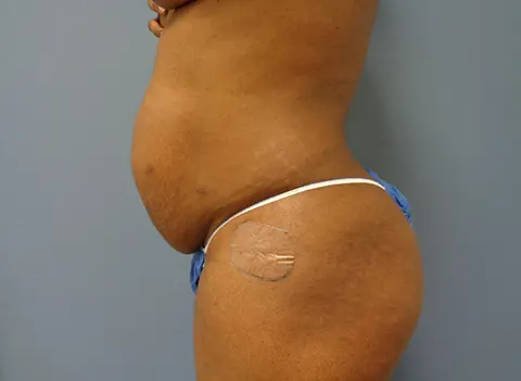 Tummy Tuck Before & After Pictures Nashville, TN