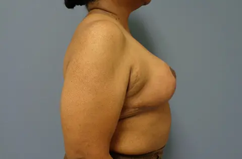 Implant Based Reconstruction Before & After Pictures in Nashville, TN