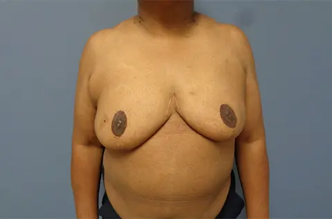 Implant Based Reconstruction Before & After Pictures in Nashville, TN