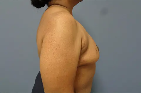 Implant Based Reconstruction Before & After Pictures in Nashville, TN