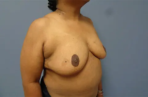 Implant Based Reconstruction Before & After Pictures in Nashville, TN