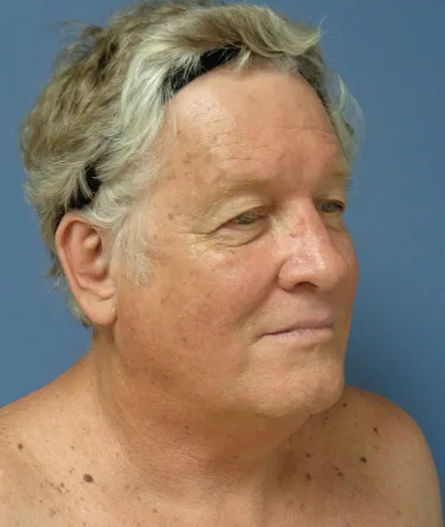 Otoplasty Before & After Pictures Nashville, TN
