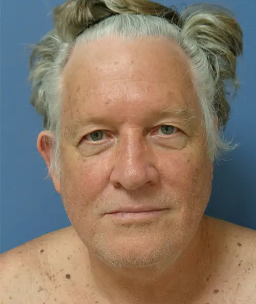 Otoplasty Before & After Pictures Nashville, TN