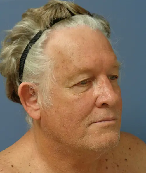 Otoplasty Before & After Pictures Nashville, TN