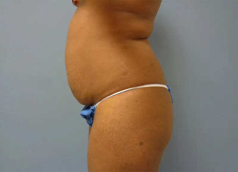 Tummy Tuck Before & After Pictures Nashville, TN