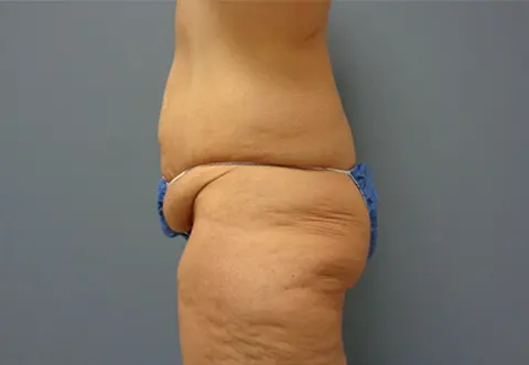 Butt Augmentation Before And After Pictures Nashville, TN