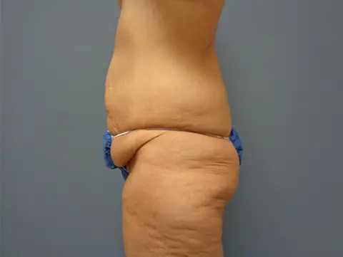 Tummy Tuck Before & After Pictures Nashville, TN